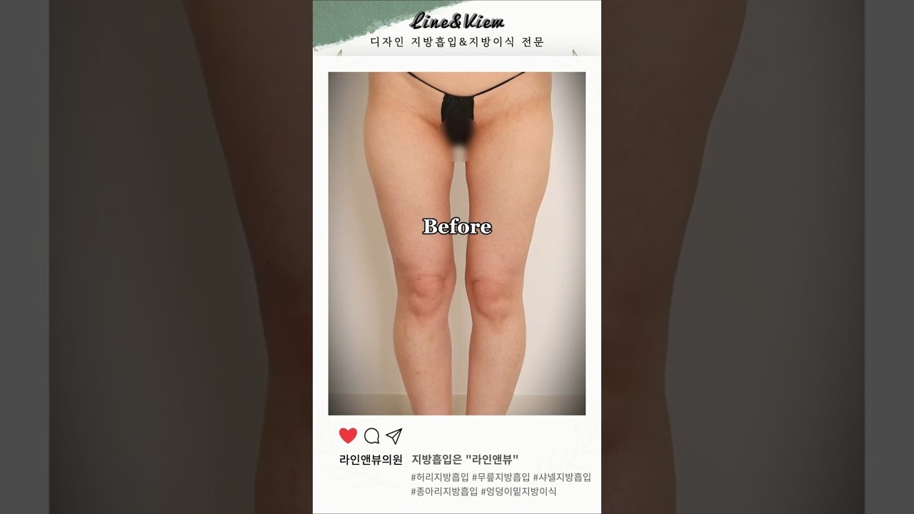 뼈다리 갖고싶어? | 허벅지지방흡입 | 허리지방흡입 | 무릎지방흡입 리얼 전후 #shorts #지방흡입후기 #지방흡입전후 #허무샤종 #엉덩이지방이식 #다리지방흡입