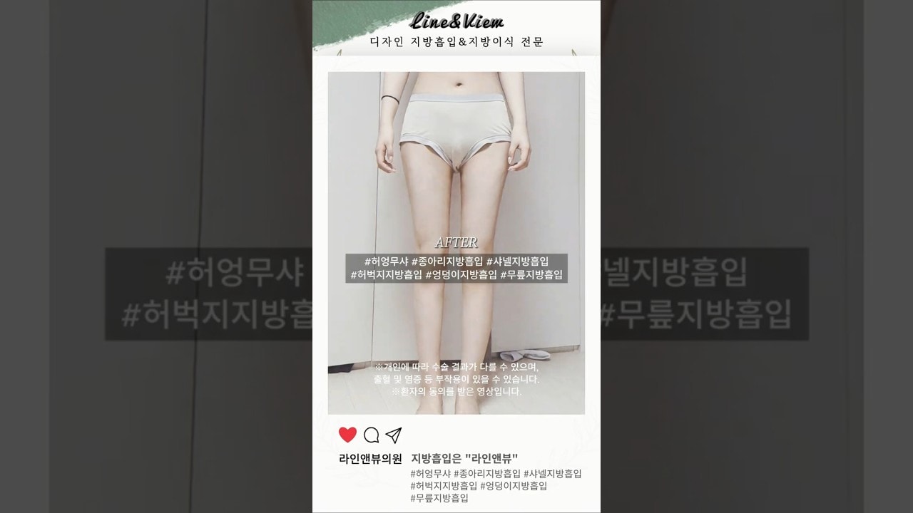 허엉무샤란→허벅지 엉덩이 무릎 샤넬 | 허벅지지방흡입 | 엉덩이지방흡입 리얼 전후 #shorts #지방흡입후기 #지방흡입전후 #허벅지대용량 #대용량지흡  #허엉무샤 #하체비만