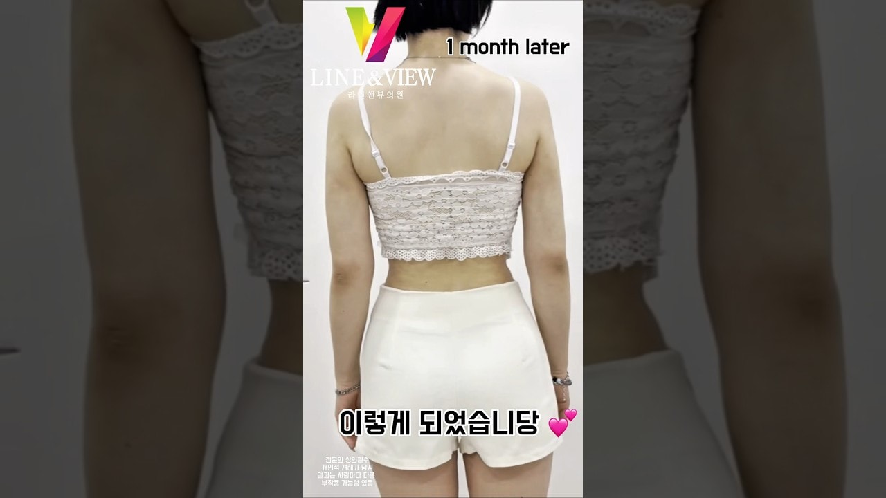 완성도 있는 비율, 믿을 수 있는 곳 ❤️팔 + 복부 라인도 라인앤뷰가 제대로 합니다  🤩여러분도 라인앤뷰 하세요 ✨#라인앤뷰 #복부지흡 #팔지흡 #후기 #지방흡입후기