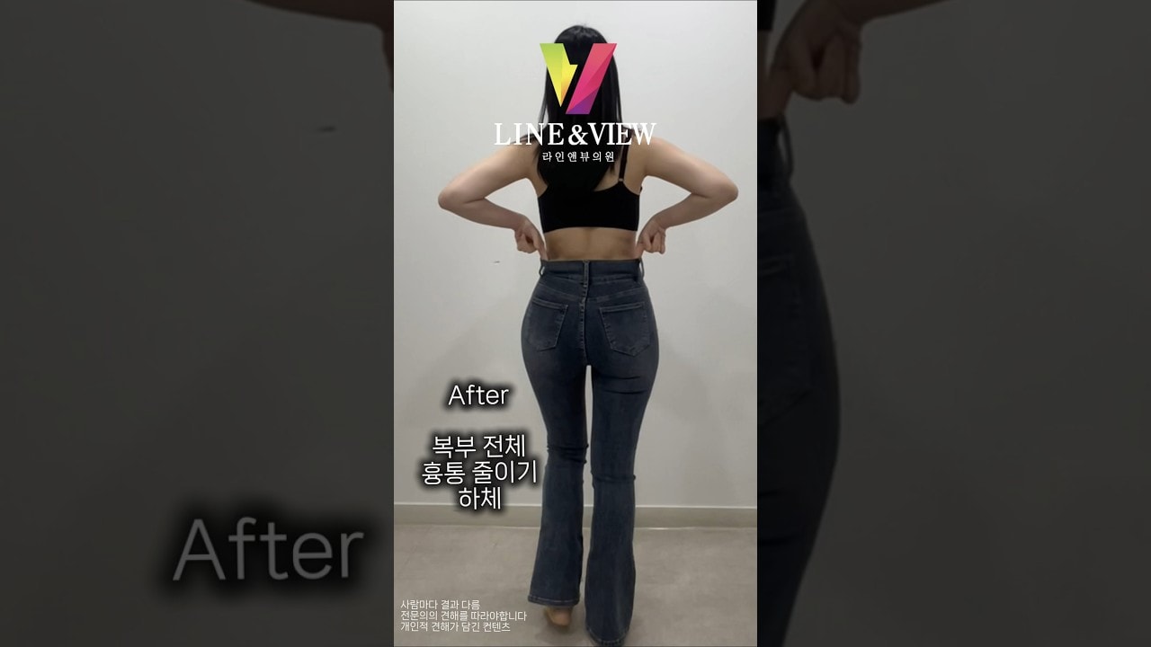 라인앤뷰에서 완벽한 상하체 라인모오오두 갖게되신 고객님💫🩷진짜 너무 예뻐서 라인 뺐고싶을 정도라니까용역시 허벅라인 허리리인은라인앤뷰 🥸👖👌#지흡 #지흡잘하는곳 #지흡병원 #다이어터