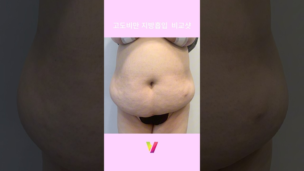 고도비만 지방흡입 리얼후기_5 #지방흡입 #고도비만