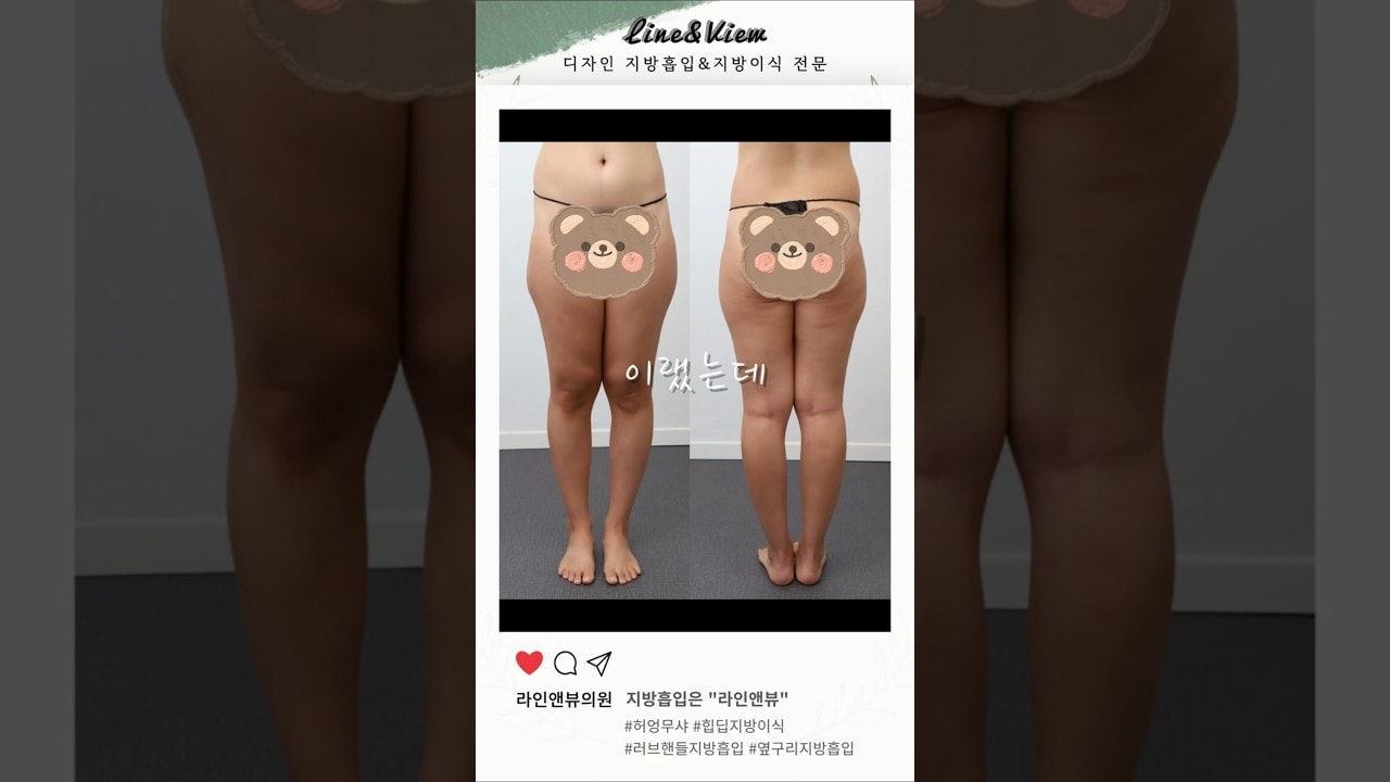 전후차이 무엇,, ? | 지방흡입 | 허엉무샤 | 골반지방이식 | 러브핸들(옆구리)지방흡입 리얼 전후 #shorts #지방흡입 #지방흡입후기 #골반지방이식 #허엉무지방흡입