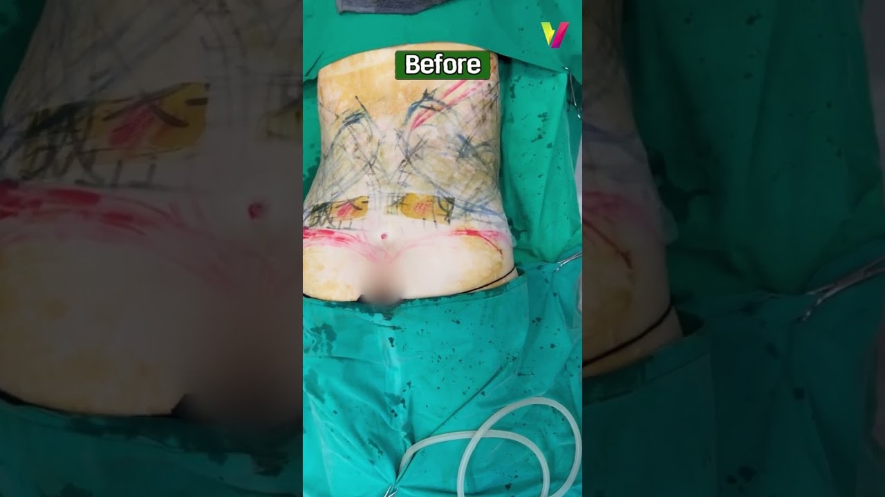 복부지방흡입 수술실 직후! 무보정 리얼!! before&after #shorts