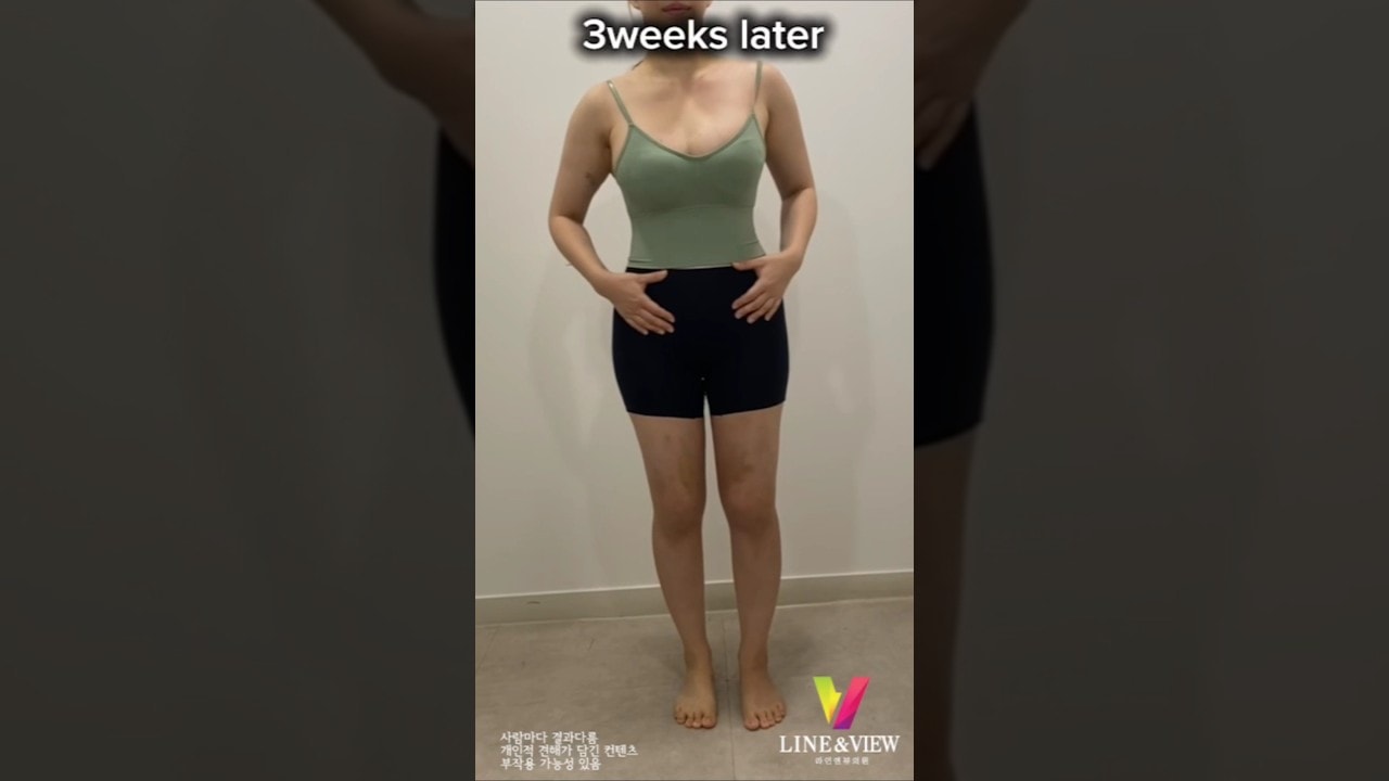 👋 뱃살은 빠이✋배 하나 줄였을 뿐인데 허리라인 완성 💕 여러분도 라인앤뷰 하세요 👍#라인앤뷰 #복부지흡 #지흡잘하는곳 #지방흡입