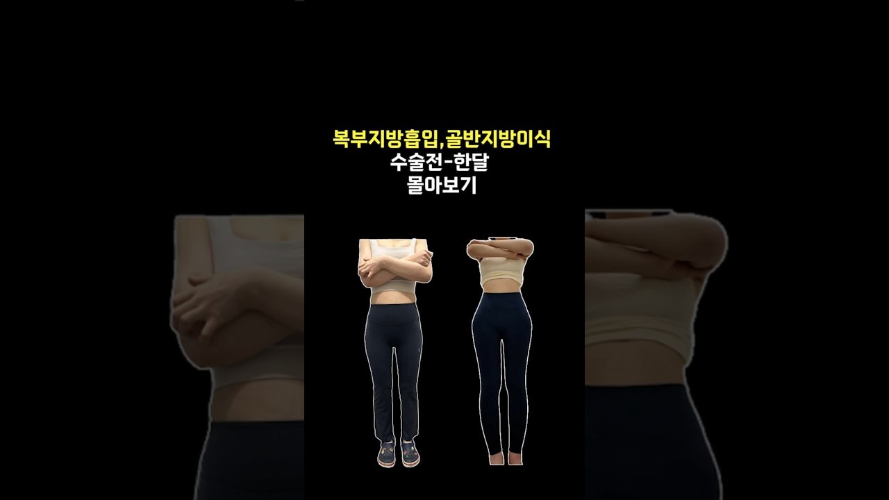 복부지방흡입+골반지방이식 수술전-한달차 공개 #shorts