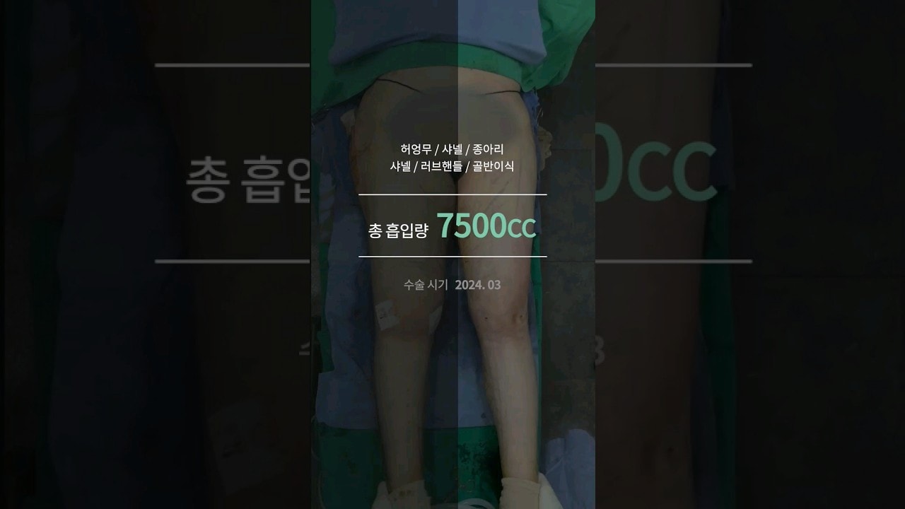 드디어 최초 공개! #지방흡입