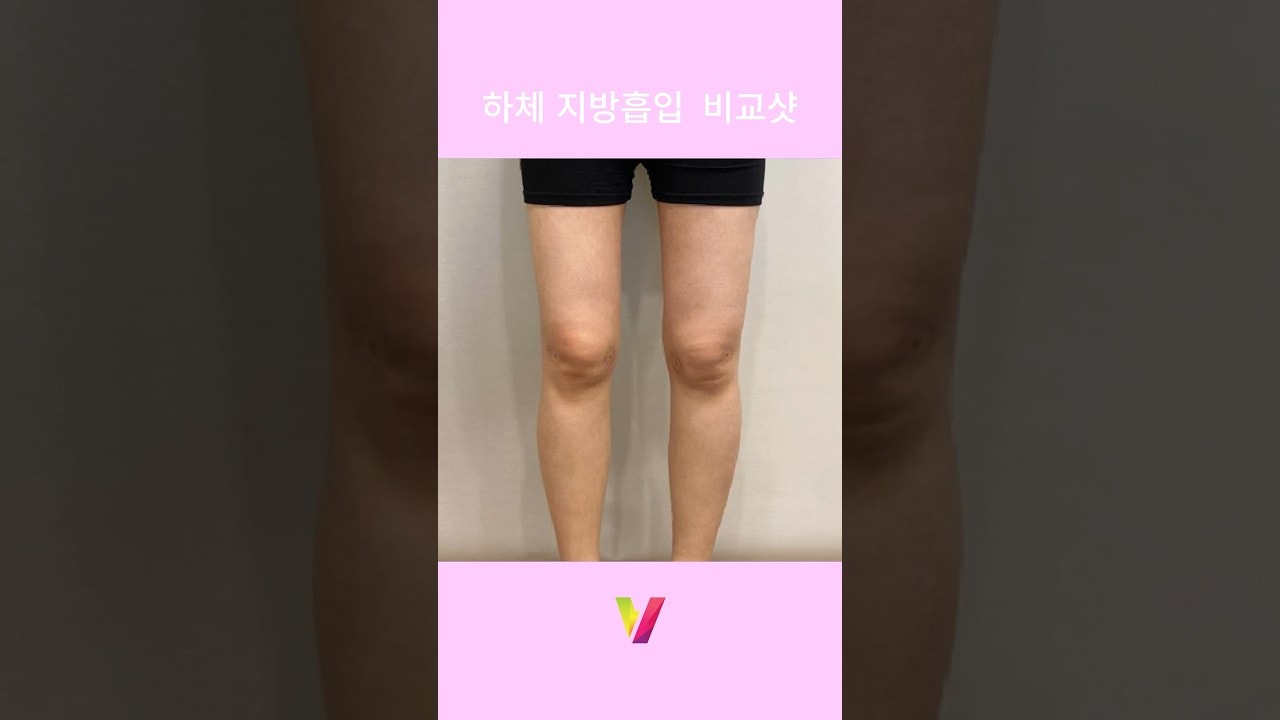 하체지방흡입 맛집, 리얼 후기_1 #지방흡입 #지방흡입후기