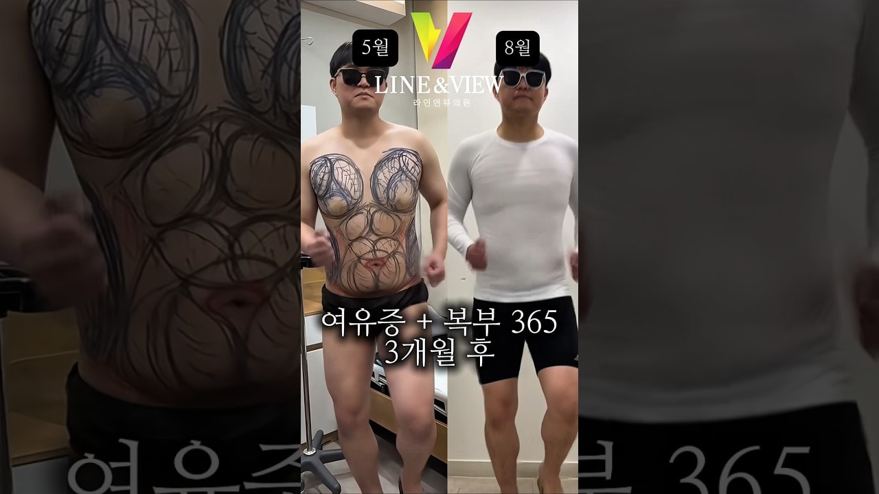 여자들만 하는 수술이라고요 ⁉️아니요. 남자분들도 많이 오십니다 💕남성 여유증, 복부, 체형 교정까지  우리 병원에서 자신감 회복하세요 ✨ #라인앤뷰 #지흡잘하는곳 #shorts