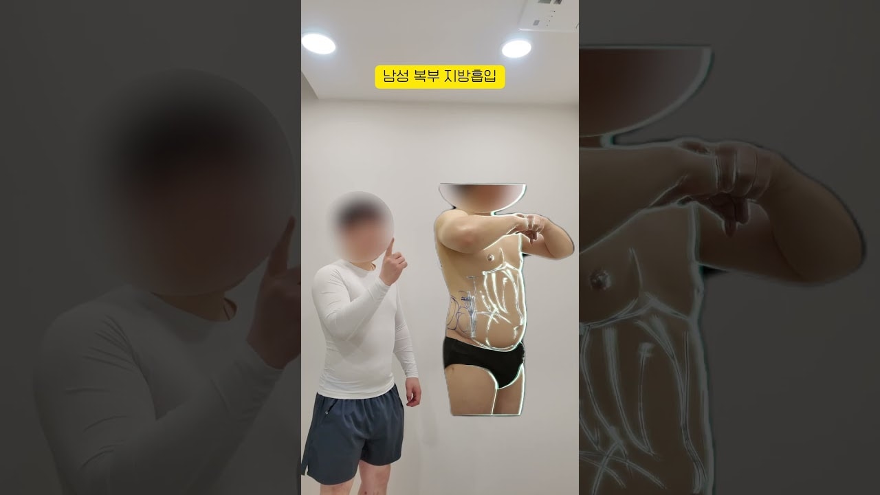 술먹고 찐 복부 지방흡입으로 이젠 안녕!! 과거의 나도 안녕!!