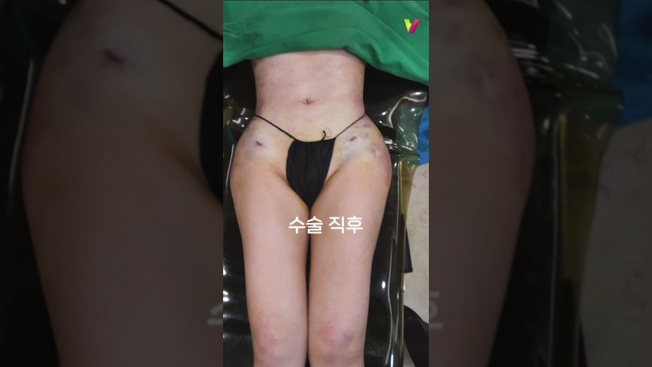 러브핸들 정리하고 골반지방이식 직후