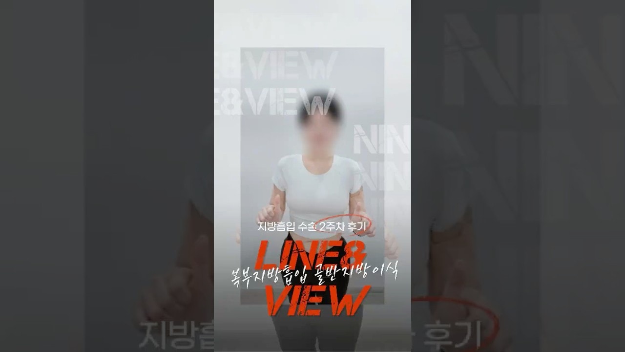 복부 지방을 골반에? 복부지방흡입 + 힙딥골반이식 동시에 하면 생기는일
