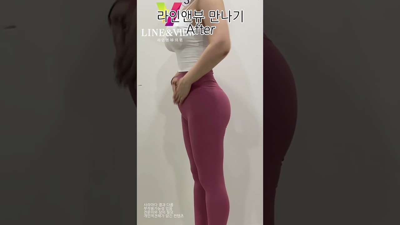 라인앤뷰에서 완벽한 라인을 갖게되신 고객님❤️🤍진짜 너무 예뻐서 라인 뺐고싶을 정도역시 허리라인은 라인앤뷰 !!!!! 🤍☁️#지흡 #지흡잘하는곳 #지흡병원 #다이어터 #디이어터