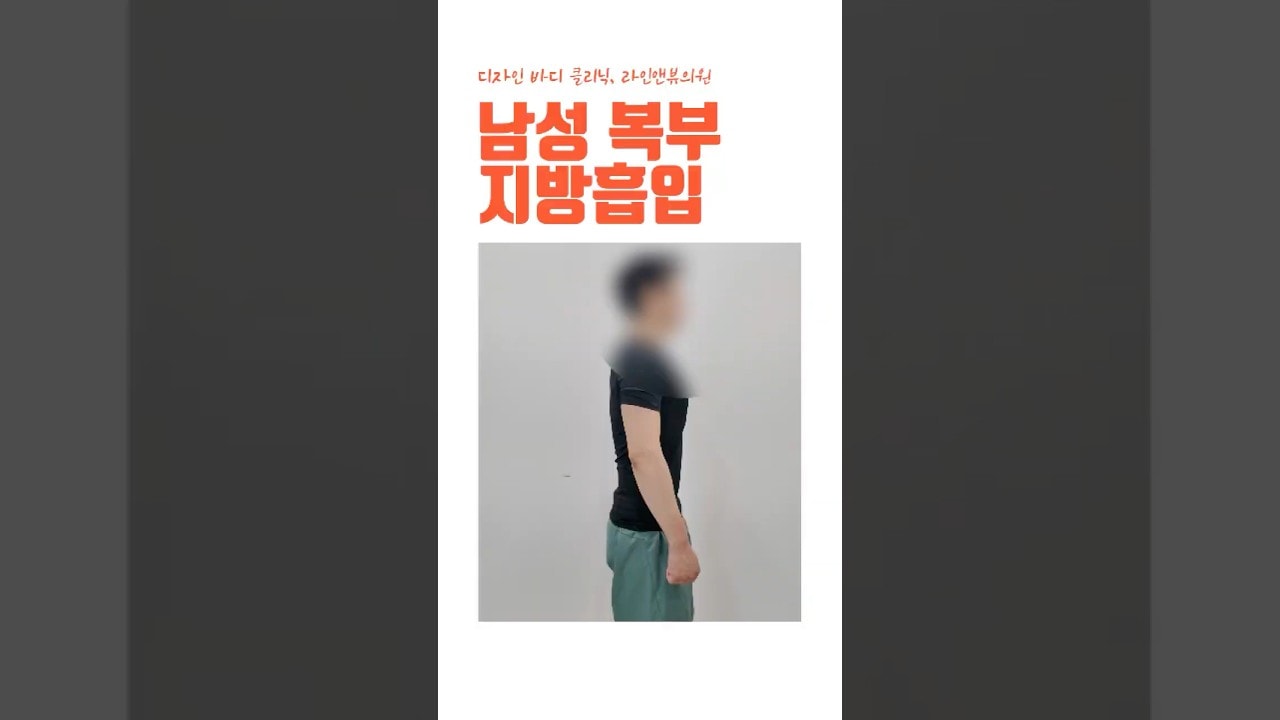 남성 복부 지방흡입 한달차 후기