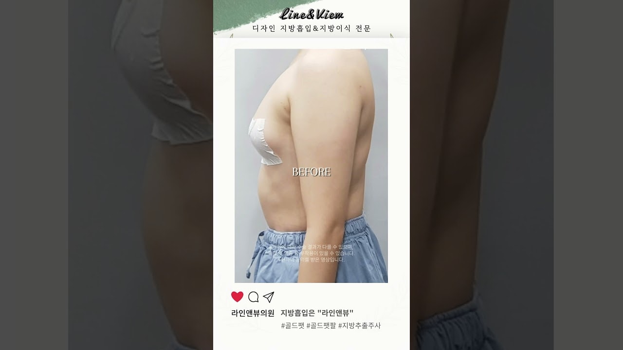 ❗수술없이 주사만으로 뼈팔가넝❗ | 골드팻 | 지방추출주사 | 골드팻팔 | 팔지방추출주사 | 리얼 전후 #shorts #골드팻 #지방추출주사 #팔지방