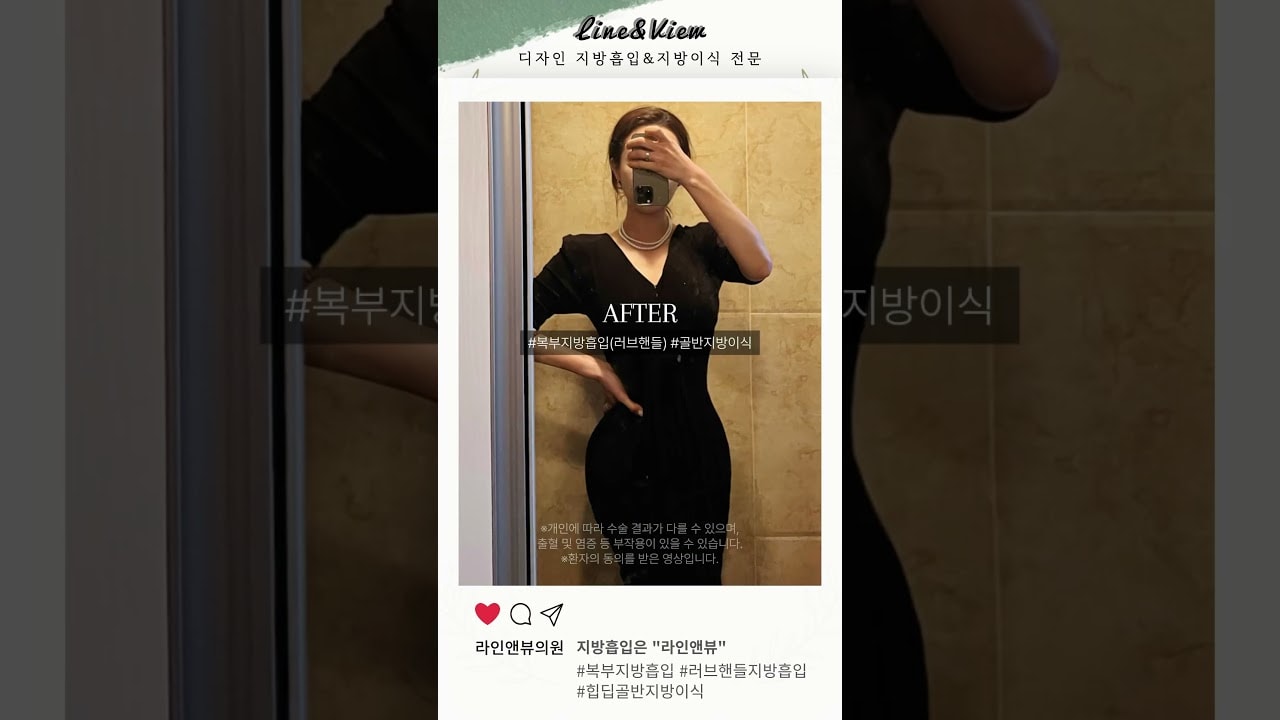 아니 이거 실화냐고; 복부(러브핸들)지방흡입 | 골반지방이식 리얼 전후 #shorts #지방흡입 #지방흡입후기 #지방이식 #골반지방이식 #복부지방흡입 #골반 #몸매