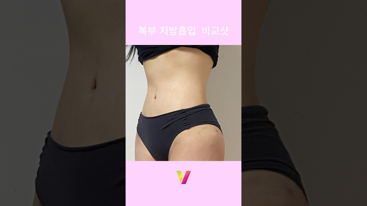 복부지방흡입 리얼후기_2 #지방흡입 #복부지흡