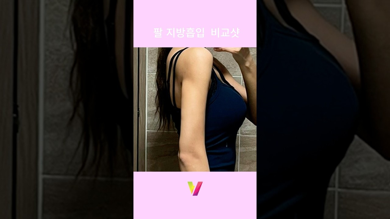 팔 지방흡입 리얼후기_3 #지방흡입 #팔뚝살