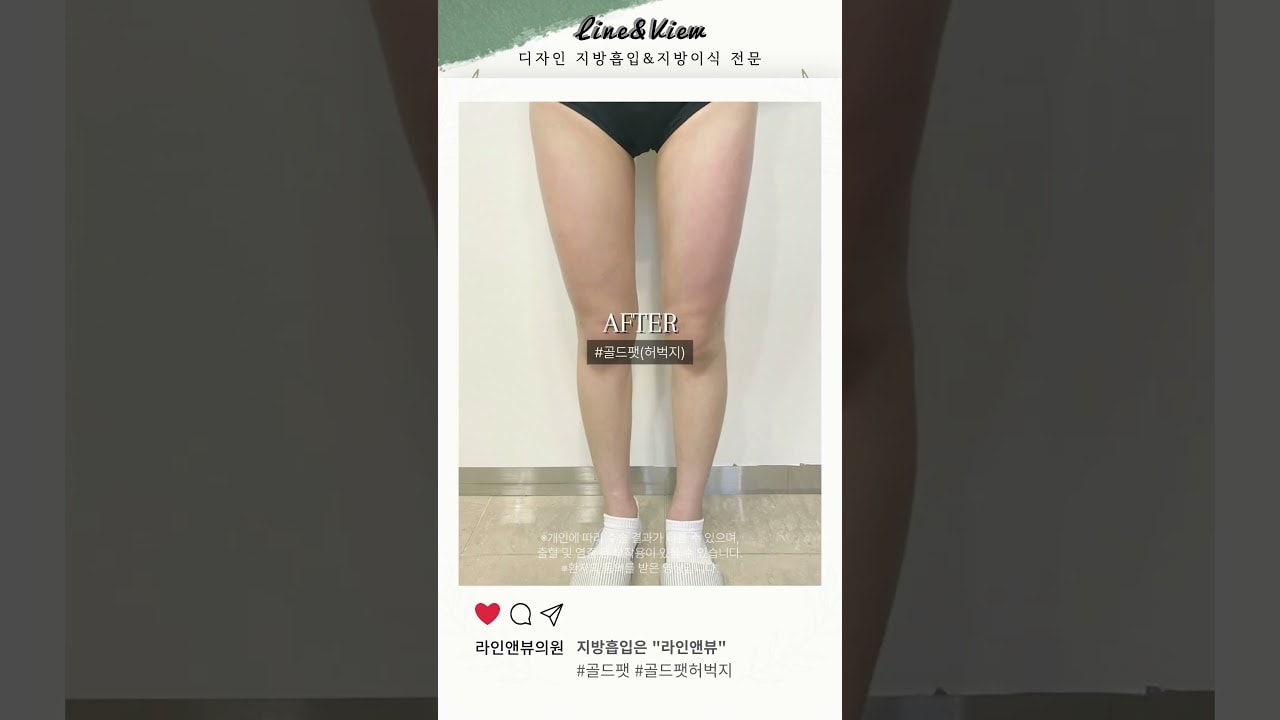 수술없이 주사만으로? 전후봐바.... | 골드팻 | 지방추출주사 | 골드팻허벅지 | 허벅지지방추출주사 | 리얼 전후 #shorts #골드팻 #지방추출주사 #허벅지지방