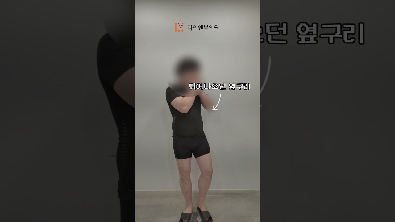 남성 복부 지방흡입 2개월차 리얼후기!