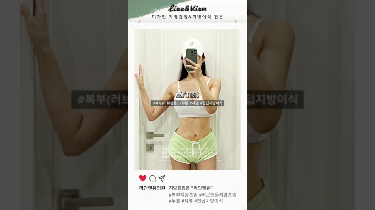 여신몸매 ssap가능 | 복부(러브핸들)지방흡입 | 골반(힙딥)지방이식 리얼 전후 #shorts #지방흡입 #지방흡입후기 #지방이식 #복부지방흡입 #골반지방이식 #힙딥지방이식