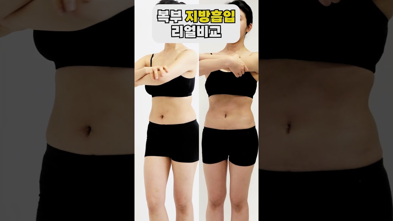 복부 지방흡입 실제사례 영상 #비만 #고도비만 #지방흡입