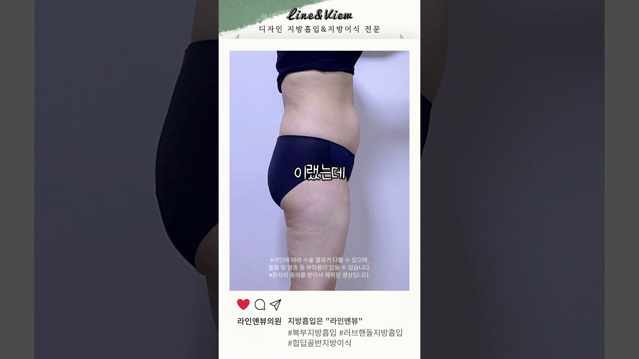 [지방흡입/이식은 라인앤뷰의원] 복부(러브핸들)지방흡입 | 골반지방이식 리얼 전후 #shorts #지방흡입 #지방흡입후기 #지방이식 #골반지방이식 #복부지방흡입 #골반 #힙딥