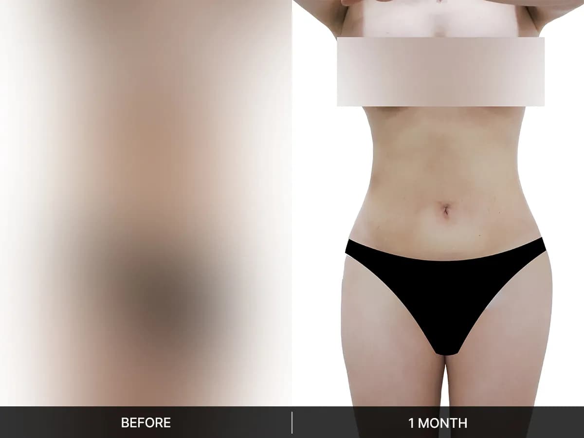 지방흡입 · 복부 / 지방이식 · 골반, 힙딥 후기 이미지