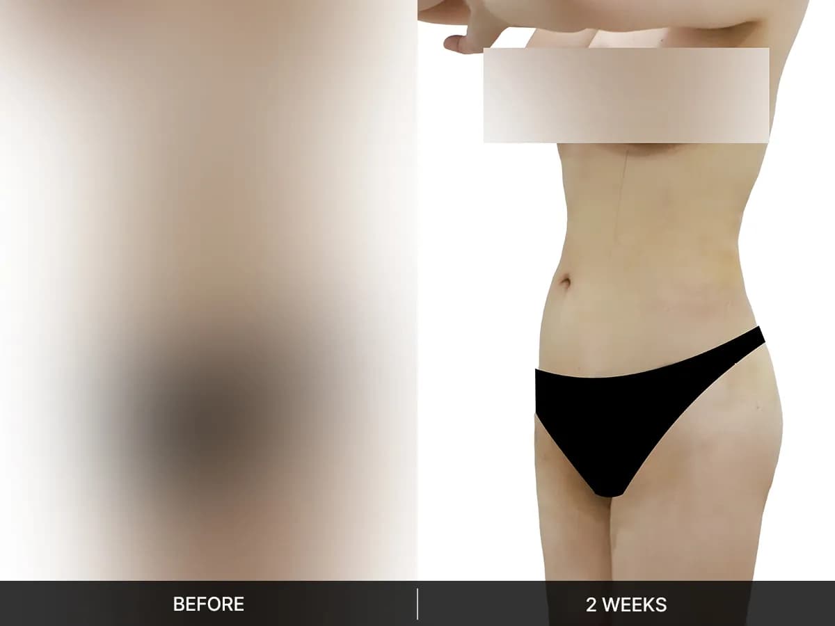지방흡입 · 복부 후기 이미지